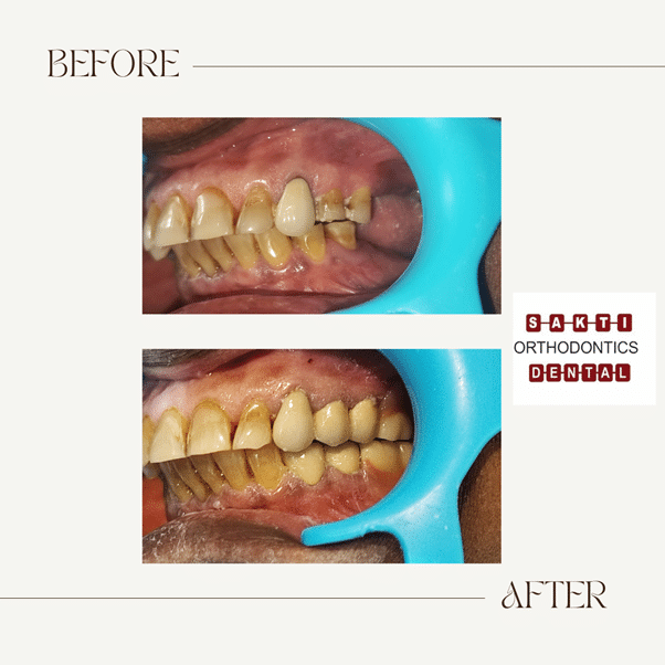 How Precision Attachments Transformed a Patient’s Life