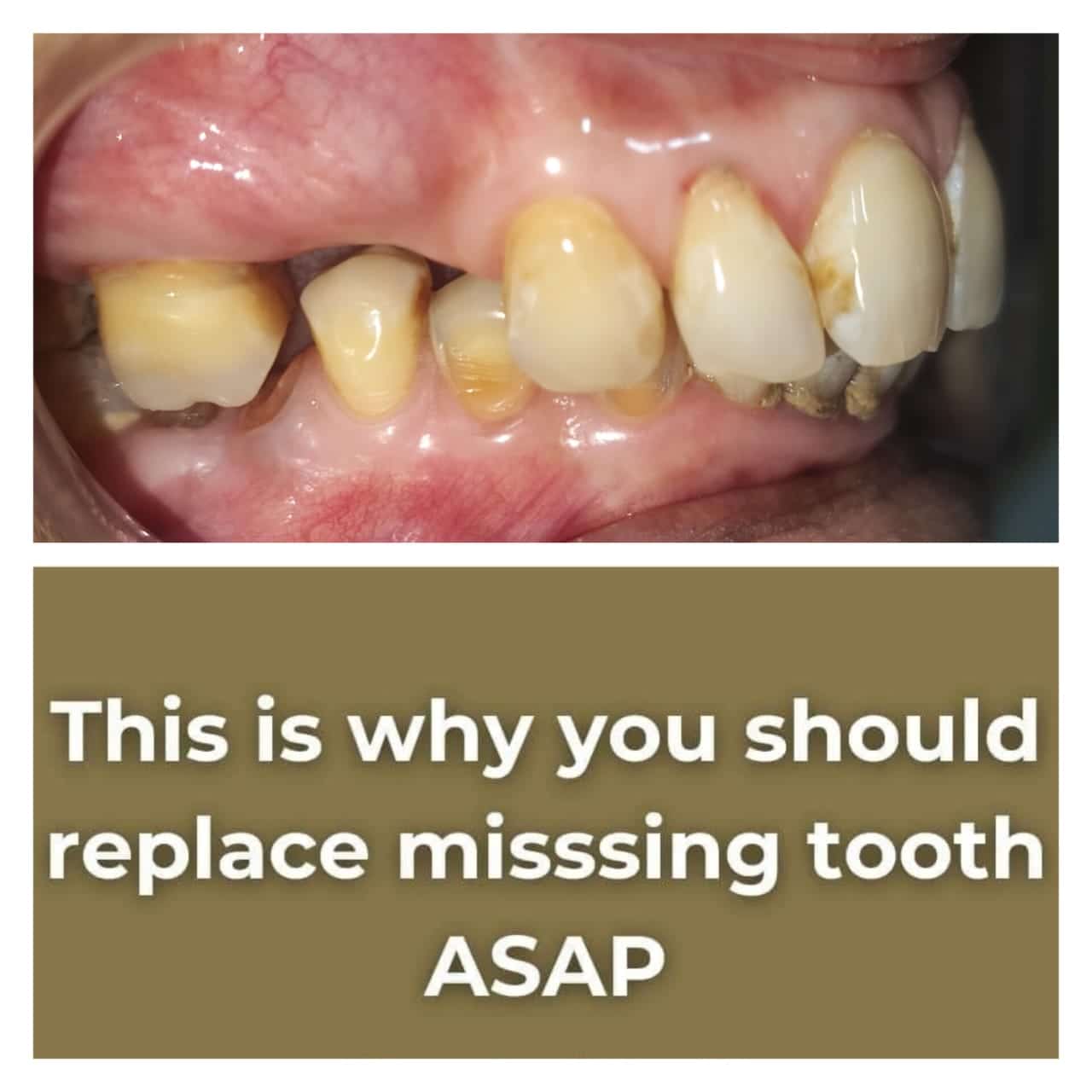 Single Dental Implants In Tirunelveli